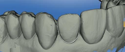 _ Abb. 6a_Digitaler Abdruck nach der Zahnpräparation. Die Abbildung zeigt das Verfahren an Zahn 22.