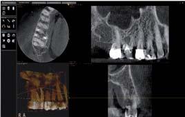 _Die Möglichkeiten der dreidimensio nalen radiologischen bildgebenden Verfahren, welche der Zahnmedizin in Form der Cone-Beam Computertomografie (CB-CT), oder in Deutschland besser