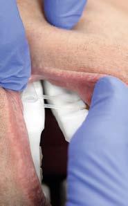 Schritt 4 Einsetzen und Anpassen der Schiene Das erstmalige Einsetzen der Schiene muss unter der Aufsicht eines Zahnarztes erfolgen.