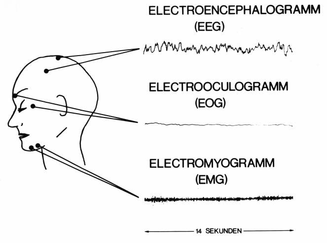 Abbildung 2-1 Abb. 2.1: EEG, EOG und EMG. Stromkurven geben Aufschluß über den Schlaf.