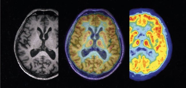 MECHAnISMEn, ursachen und AuSlöSER 40 Aufnahme des Gehirns, gewonnen durch Magnet resonanztomografie (links) und durch Positronenemmissions tomografie (rechts).