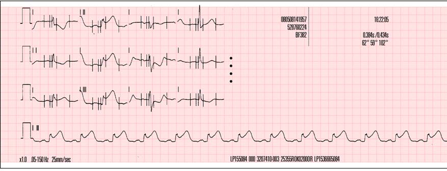 Aufzeichnung eines 12-Ableitungen-EKGs avl -avr avf V1 V2 V3 V4 V5 V6 Name: ID#: Patienten-ID: Vorfall: Alter: 50 Lee, William Geschlecht: M 12 Ableitungen 1 24.