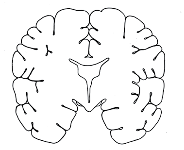 Hirnrinde Hirnrinde stark geschädigt Sprache Hippocampus (emotionen Triebverhalten) Gesundes gehirn Erinnerung stark geschrumpfter Hippocampus Hohlraum Stark Vergrössert fortgeschrittene