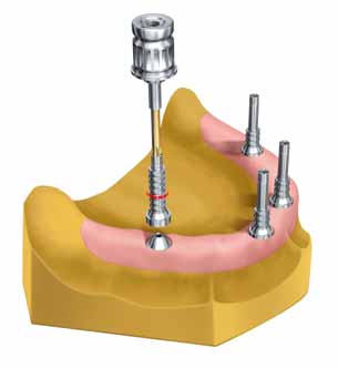 All-on-4 Laborverfahren Schritt für Schritt Vollkunststoffbrücke fertigen Fertigen Sie ein Meistermodell mit Zahnfleischmaske mit Abutment Replikas Multi-unit.