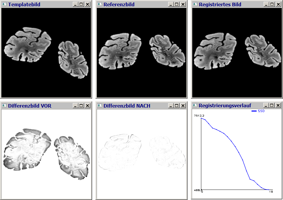 5.1 Software für die messtechnische Erforschung Abbildung 5.4: Bildausgabe der PC Software - Gehirn Abbildung 5.5: Bildausgabe der PC Software - Tumor wie in Abschnitt 3.3 vorgestellt.