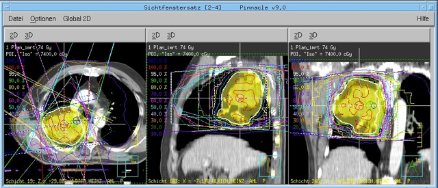 Abbildung 4.4: Beispielhafte Darstellung einer IMRT Bestrahlungsplanung anhand eines Patienten aus diesem Patientenkollektiv.