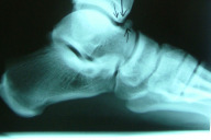 Klumpfuß percutane Achillotenotomie Klumpfuß - Schienenbehandlung Sicherung der Fuß-Außenrotation durch: Fuß-Abduktions-Orthese, ALFA-Flex-Brace, ehemals Dennis-Brown-Schiene