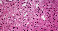 WHO-Klassifikation der Nierentumoren Histologische Einteilung: konventionelles/klarzelliges NZK (70-80%) Papilläres Nierenzellkarzinom Typ I + II (10-20%)