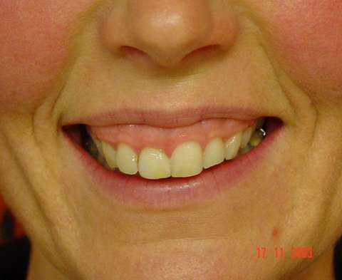 Zahnfleisch-Lächeln: Ergebnisse