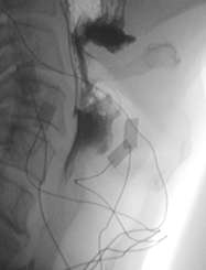 32 4. Ergebnisse 4.3.4. Videofluoroskopie Die Abbildung 4.3 zeigt zwei Bildausschnitte aus einer radiologischen Schluckuntersuchung 14.