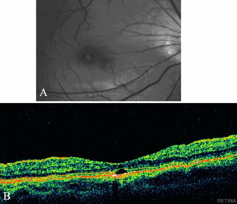 Solare Makulopathie oft bilateral, aber asymmetrisch, prominenter am dominantem Auge. Schaden am PR am größten (fokaler Verlust - äuß.