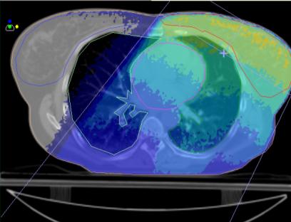 Monte Carlo Simulation Virtual Energy Fluence model Gaussförmige Quellen: target and flattening filter Elektronen
