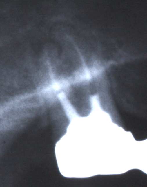 Ergebnisse 47 Abbildung 13a: Endodontisch behandelter Zahn 23 mit apikalem Herd Abbildung 13b: Vollständig verknöcherte Resektionslakune des Zahnes 23 nach WSR Bei fünf
