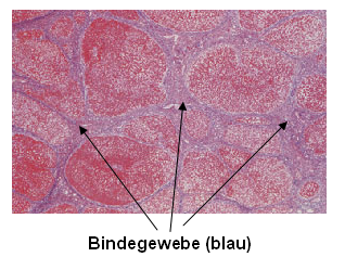 Patienten und Methode Fibrose Die Fibrosierung, d.h. der Ersatz des Parenchyms durch Bindegewebe, stellt einen möglichen Reaktionsweg des Lebergewebes auf Schädigung jeglicher Art dar.