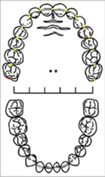 Anhang den ersten großen Backenzahn im rechten Oberkiefer. Mesial bedeutet zur Zahnbogenmitte hin und distal von der Zahnbogenmitte weg.