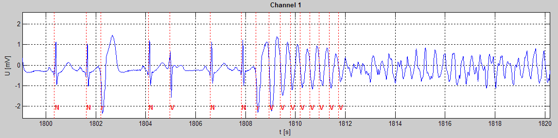 3.5 Störgrößen des EKG-Signals 35 Abbildung 3.