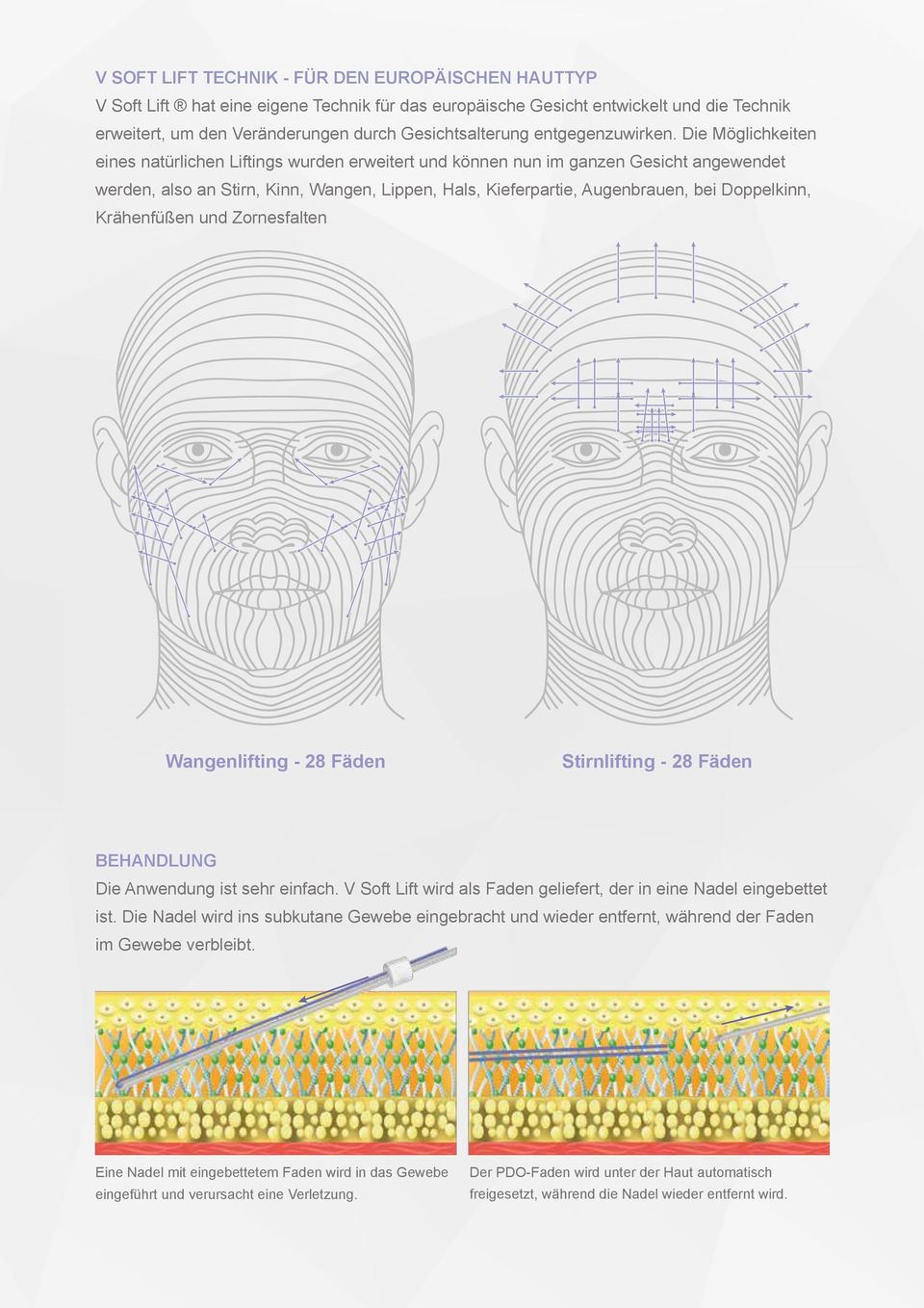 Die Möglichkeiten eines natürlichen Liftings wurden erweitert und können nun im ganzen Gesicht angewendet werden, also an Stirn, Kinn, Wangen, Lippen, Hals, Kieferpartie, Augenbrauen, bei Doppelkinn,