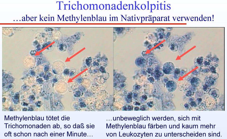 Methylenblau tötet die Trichomonaden ab, so daß sie oft schon