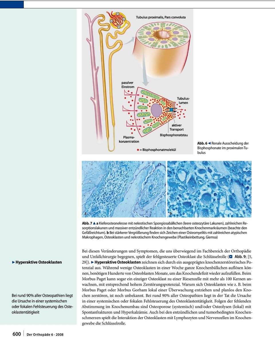 7 8 a Kieferosteonekrose mit nekrotischen Spongiosabälkchen (leere osteozytäre Lakunen), zahlreichen Resorptionslakunen und massiver entzündlicher Reaktion in den benachbarten Knochenmarkräumen