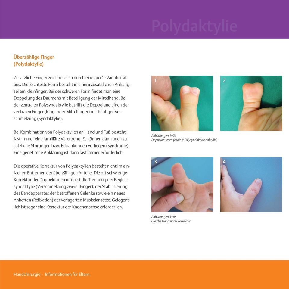 Bei der zentralen Polysyndaktylie betrifft die Doppelung einen der zentralen Finger (Ring- oder Mittelfinger) mit häutiger Verschmelzung (Syndaktylie).