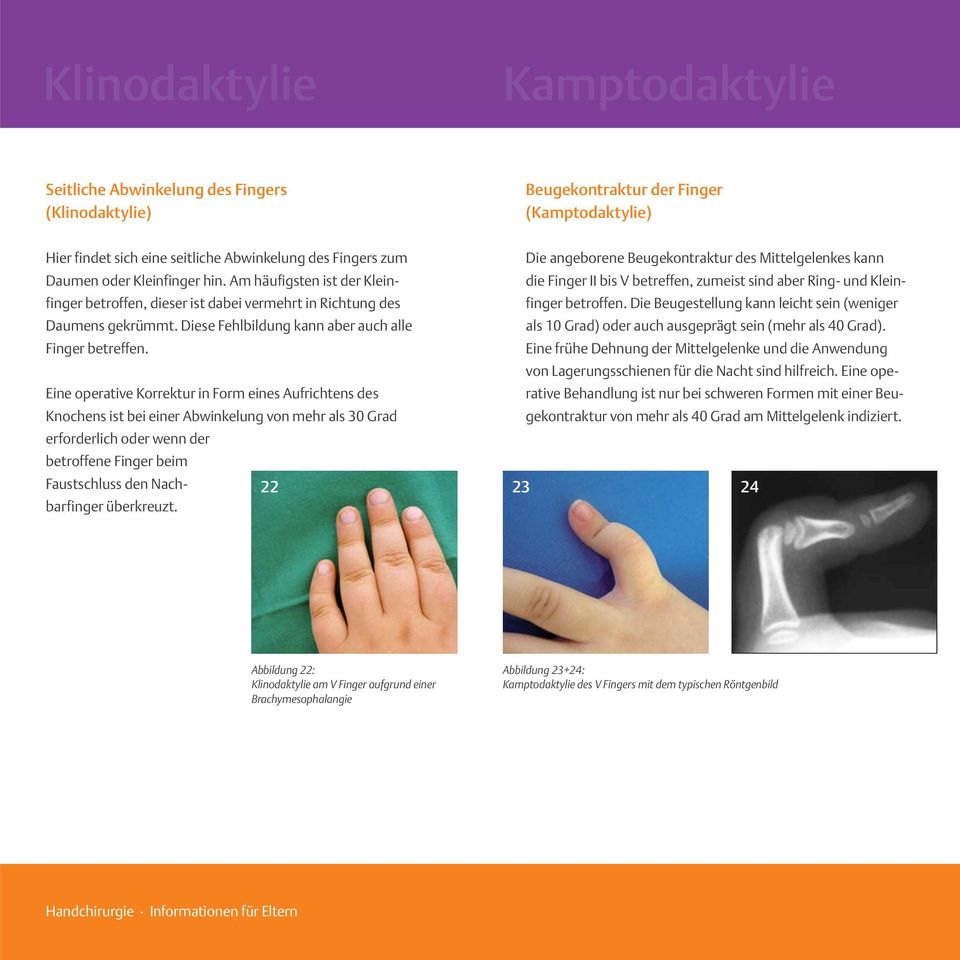 Die angeborene Beugekontraktur des Mittelgelenkes kann die Finger II bis V betreffen, zumeist sind aber Ring- und Kleinfinger betroffen.