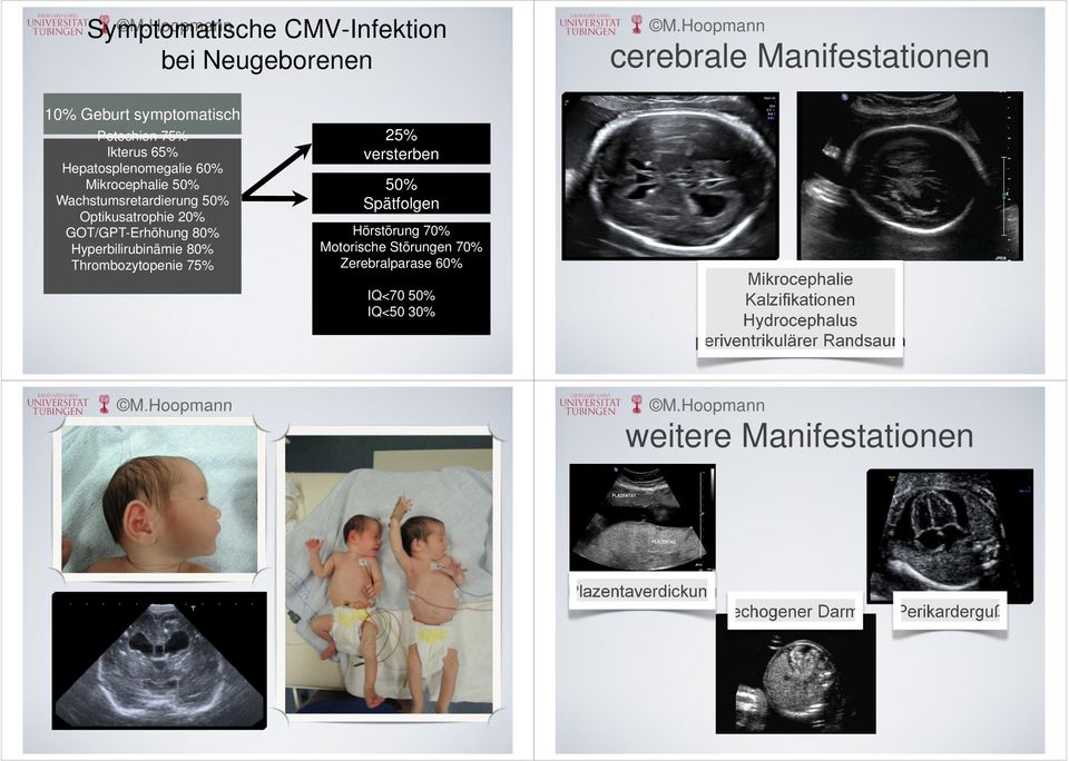 Thrombozytopenie 75% 25% versterben 50% Spätfolgen Hörstörung 70% Motorische Störungen 70% Zerebralparase 60% IQ<70 50% IQ<50 30%