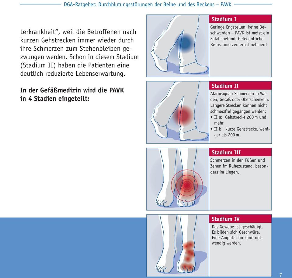 In der Gefäßmedizin wird die PAVK in 4 Stadien eingeteilt: Stadium I Geringe Engstellen, keine Beschwerden PAVK ist meist ein Zufallsbefund. Gelegentliche Beinschmerzen ernst nehmen!