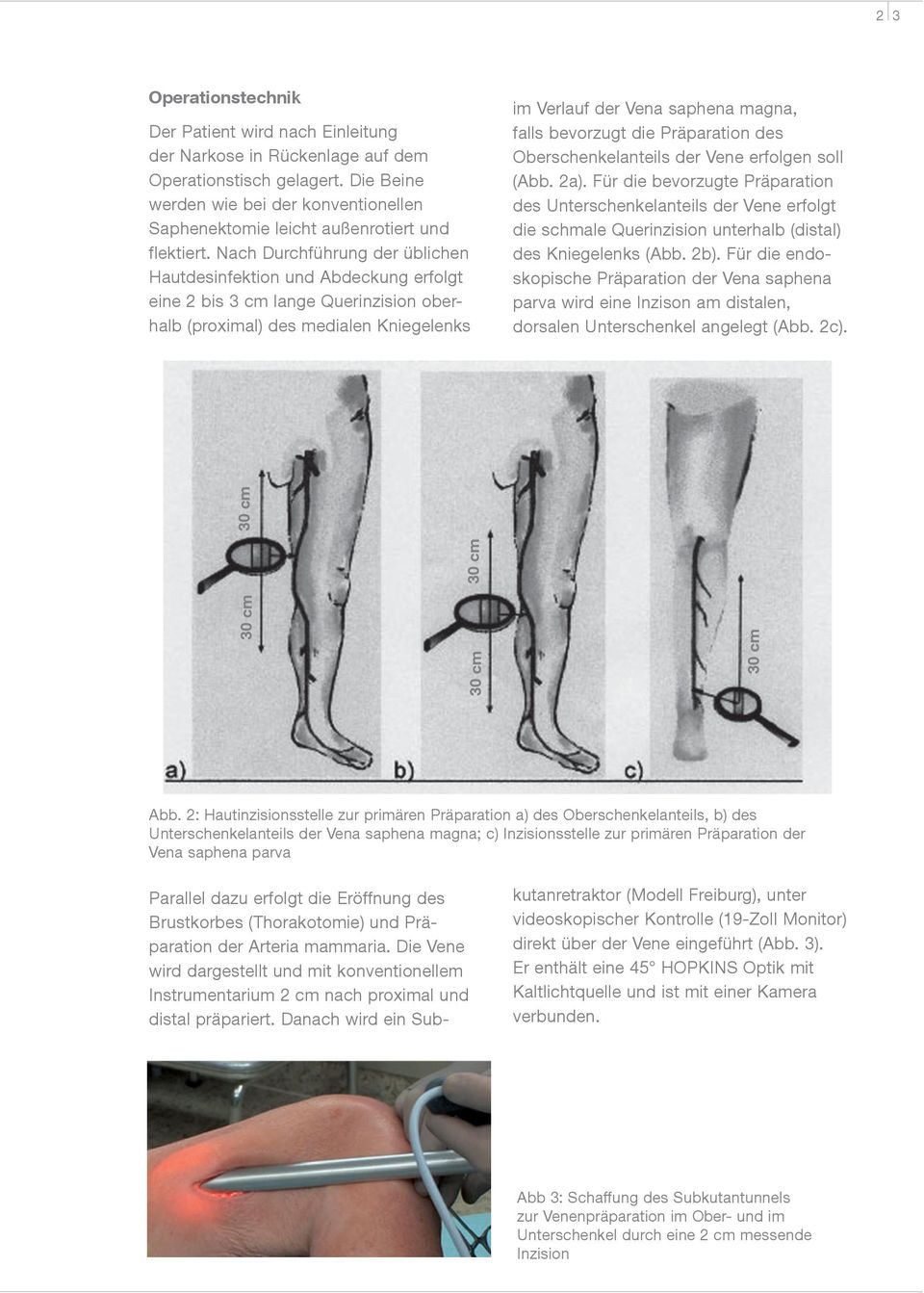 Nach Durchführung der üblichen Hautdesinfektion und Abdeckung erfolgt eine 2 bis 3 cm lange Querinzision oberhalb (proximal) des medialen Kniegelenks im Verlauf der Vena saphena magna, falls