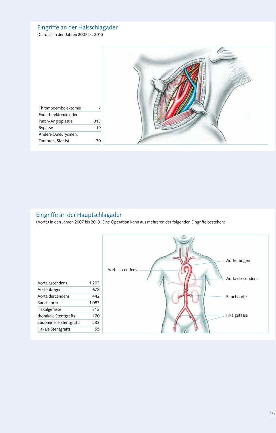 Eine Operation kann aus mehreren der folgenden Eingriffe bestehen: Aortenbogen Aorta ascendens Aorta ascendens 1 203 Aortenbogen 678 Aorta