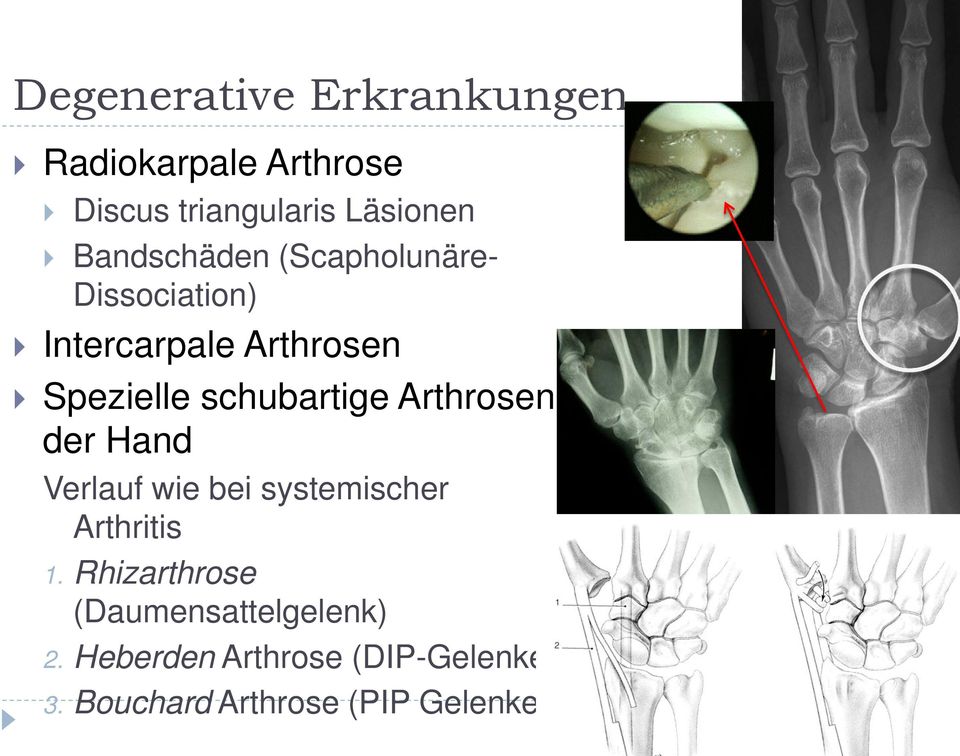 schubartige Arthrosen der Hand Verlauf wie bei systemischer Arthritis 1.