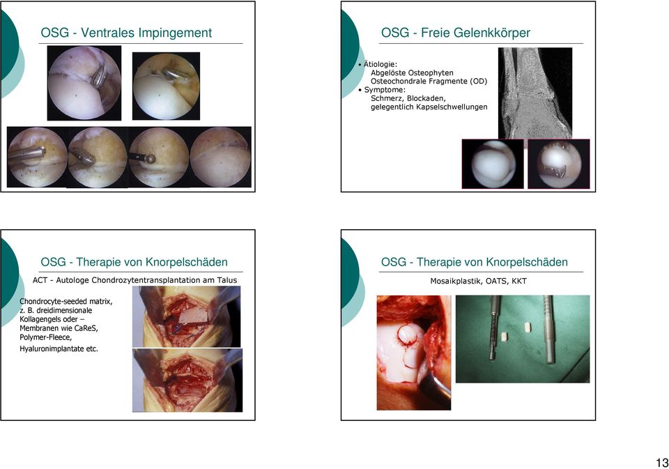 Autologe Chondrozytentransplantation am Talus OSG - Therapie von Knorpelschäden Mosaikplastik, OATS, KKT
