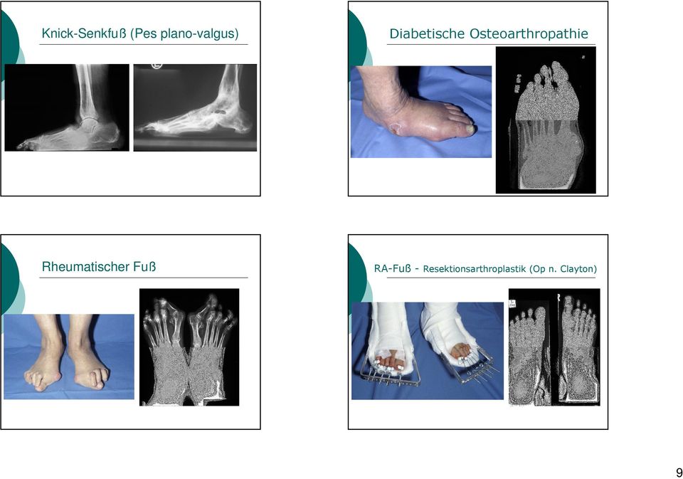 Osteoarthropathie RA-Fuß -