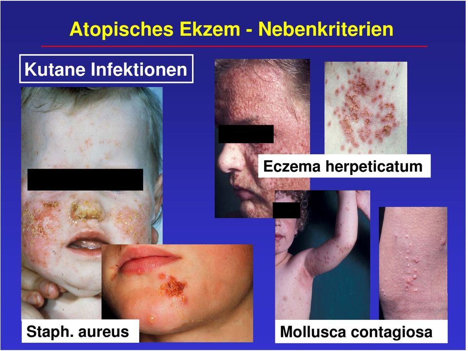 Infektionen Eczema