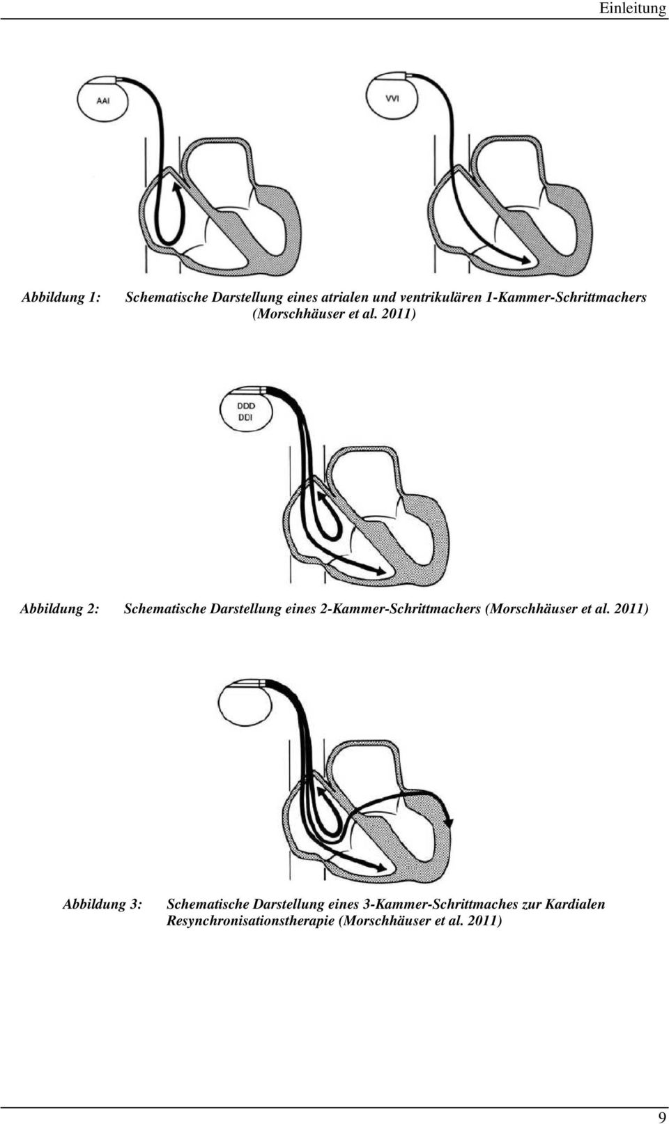 2011) Abbildung 2: Schematische Darstellung eines 2-Kammer-Schrittmachers (Morschhäuser et