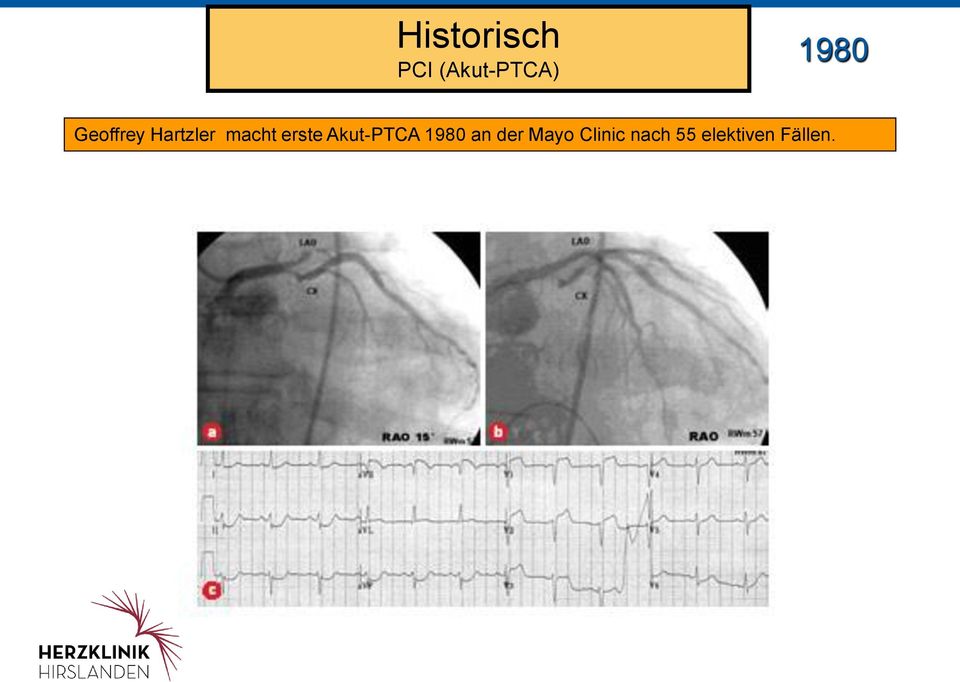 Akut-PTCA 1980 an der Mayo Clinic