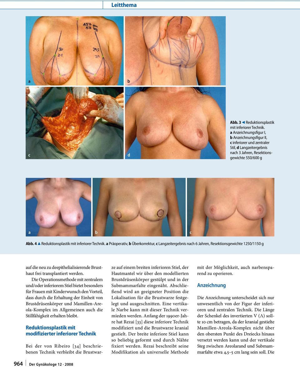 a Präoperativ, b Überkorrektur, c Langzeitergebnis nach 6 Jahren, Resektionsgewichte 1250/1150 g auf die neu zu deepithelialisierende Brusthaut frei transplantiert werden.