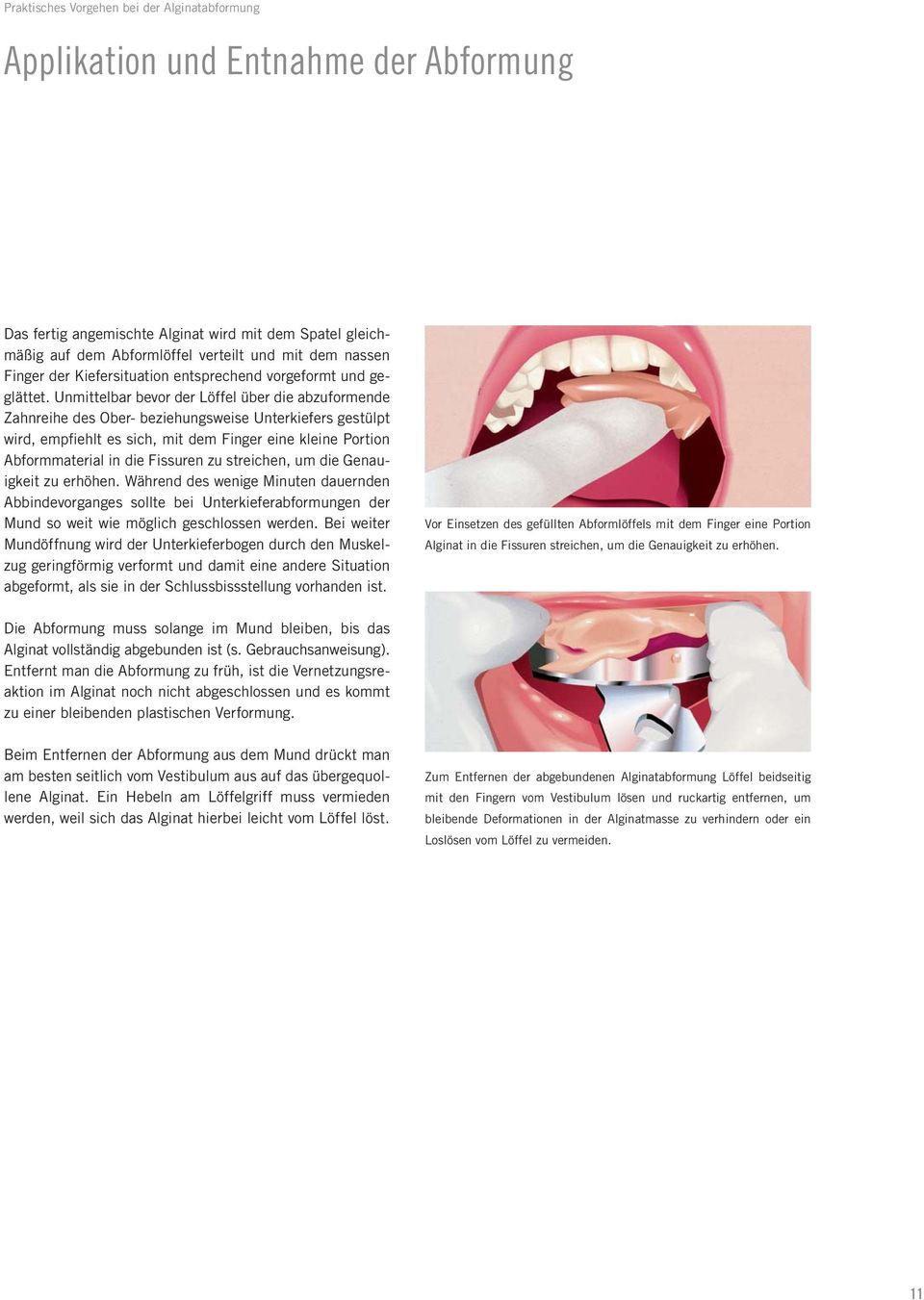 Unmittelbar bevor der Löffel über die abzuformende Zahnreihe des Ober- beziehungsweise Unterkiefers gestülpt wird, empfiehlt es sich, mit dem Finger eine kleine Portion Abformmaterial in die Fissuren