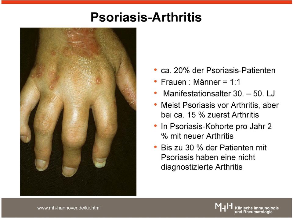 LJ Meist Psoriasis vor Arthritis, aber bei ca.
