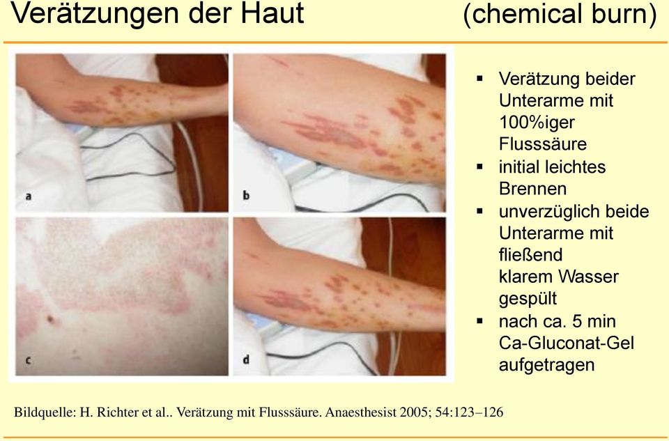 gespült nach ca. 5 min Ca-Gluconat-Gel aufgetragen Bildquelle: H. Richter et al.