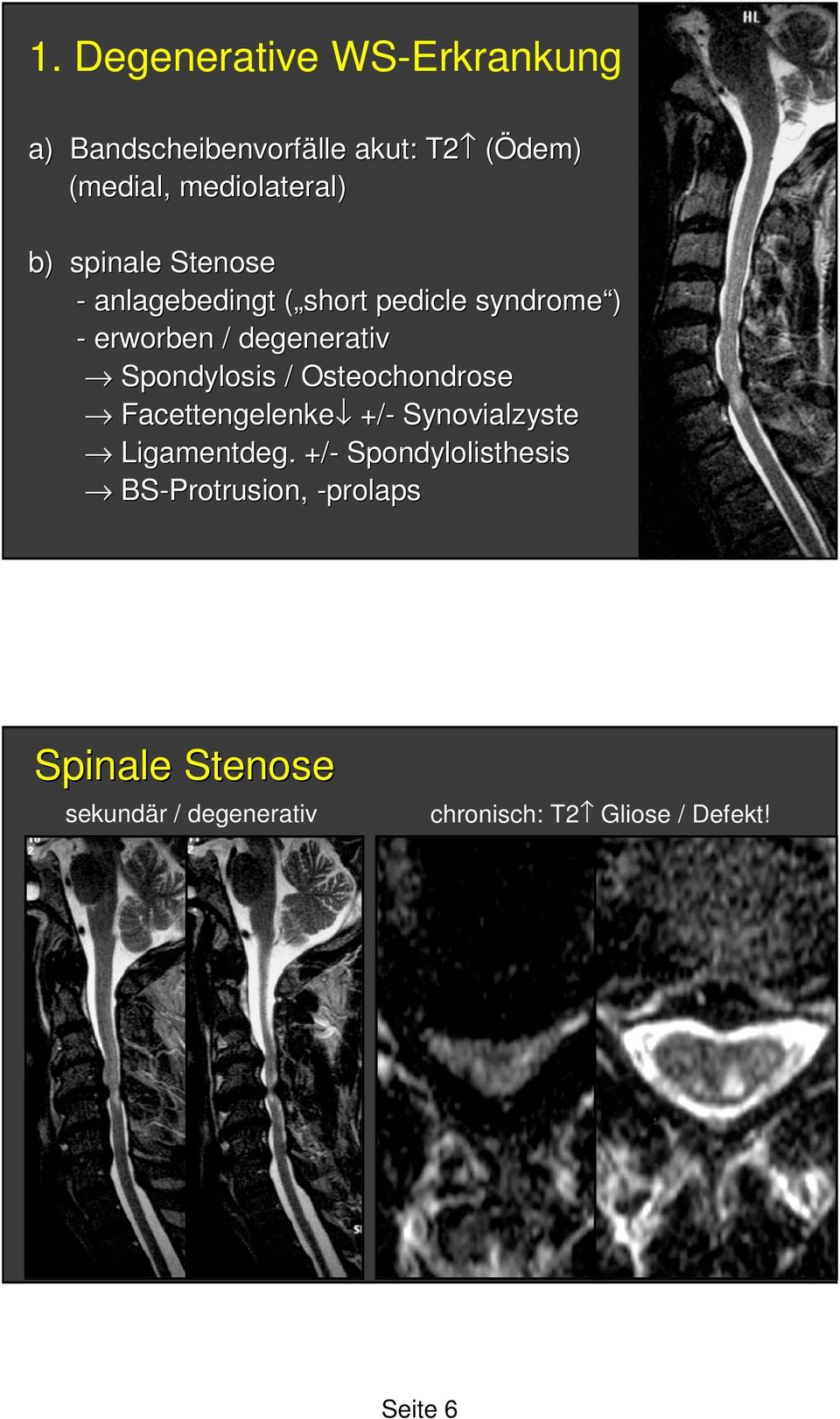 Spondylosis / Osteochondrose Facettengelenke Facettengelenke +/+/- Synovialzyste Ligamentdeg.