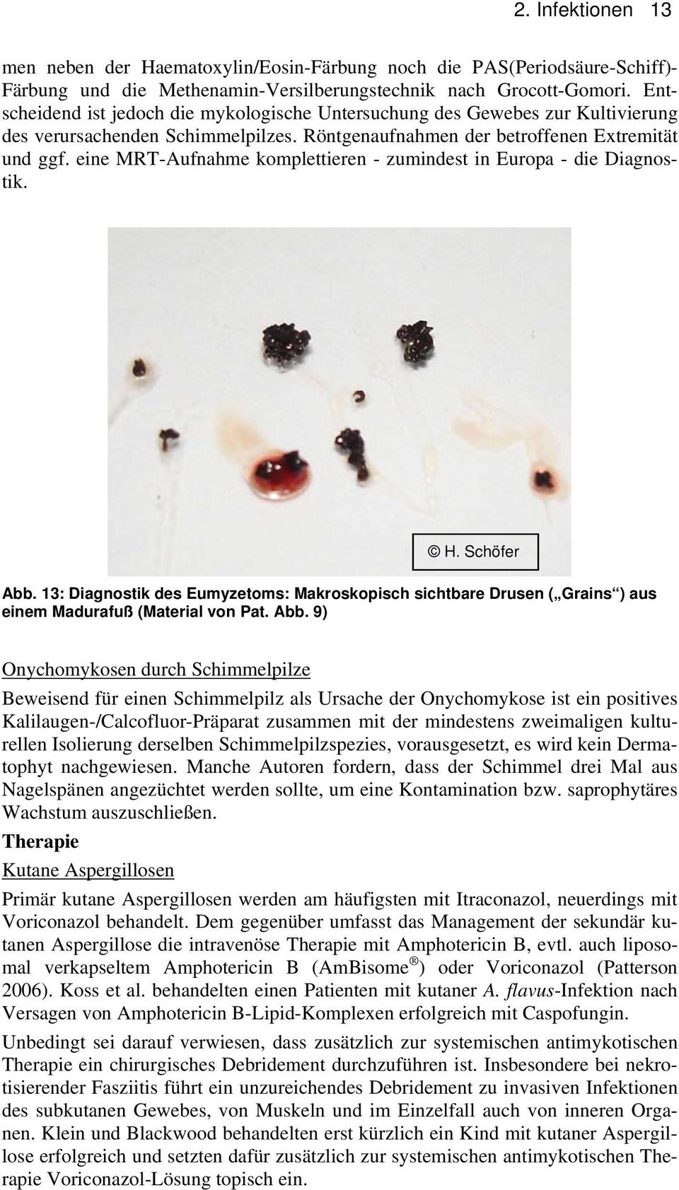 eine MRT-Aufnahme komplettieren - zumindest in Europa - die Diagnostik. H. Schöfer Abb. 13: Diagnostik des Eumyzetoms: Makroskopisch sichtbare Drusen ( Grains ) aus einem Madurafuß (Material von Pat.