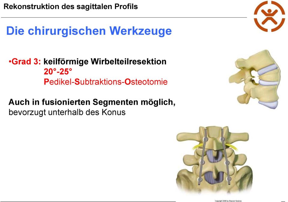 Pedikel-Subtraktions-Osteotomie Auch in