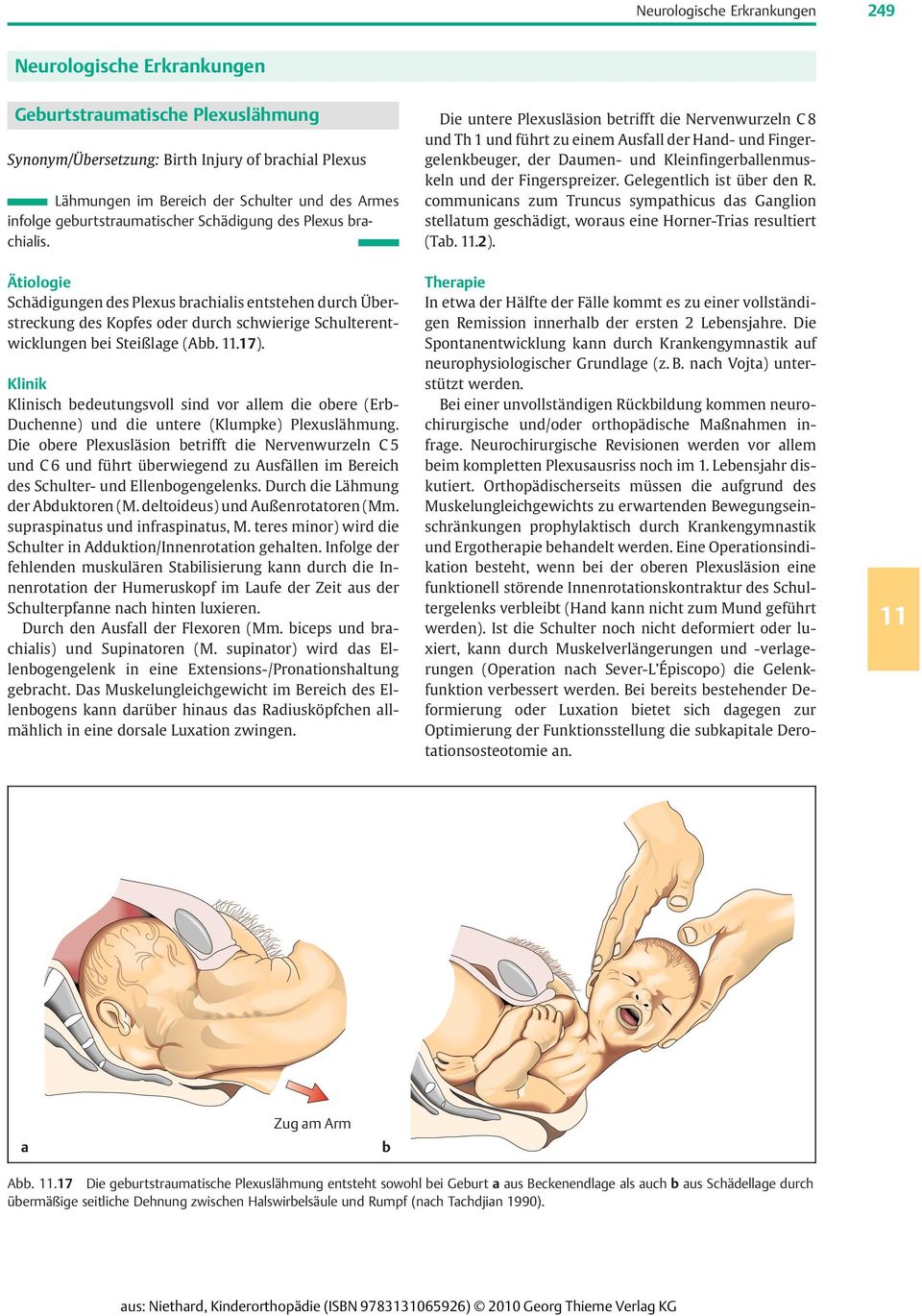 Ätiologie Schädigungen des Plexus brachialis entstehen durch Überstreckung des Kopfes oder durch schwierige Schulterentwicklungen bei Steißlage (Abb. 11.17).