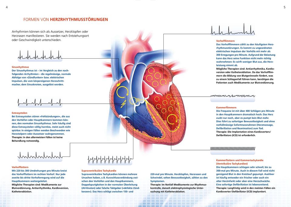 elektrischen Impulsen, die vom körpereigenen Herzschrittmacher, dem Sinusknoten, ausgelöst werden. Vorhofflimmern Das Vorhofflimmern zählt zu den häufigsten Herzrhythmusstörungen.