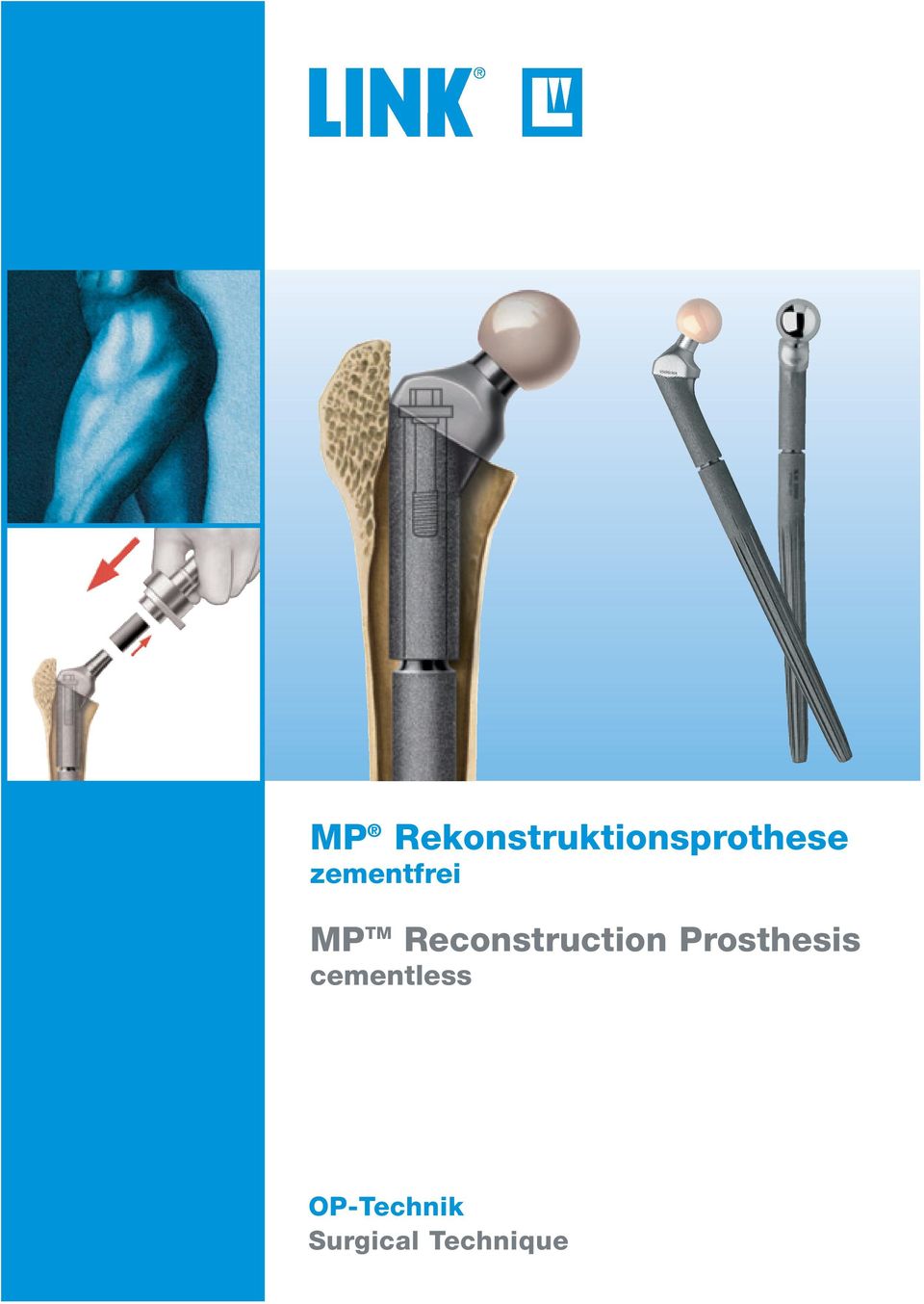 Reconstruction Prosthesis