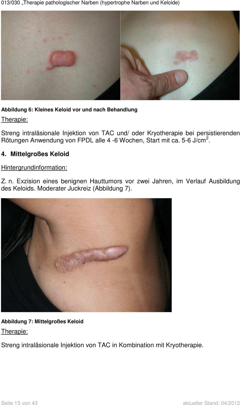 n. Exzision eines benignen Hauttumors vor zwei Jahren, im Verlauf Ausbildung des Keloids. Moderater Juckreiz (Abbildung 7).