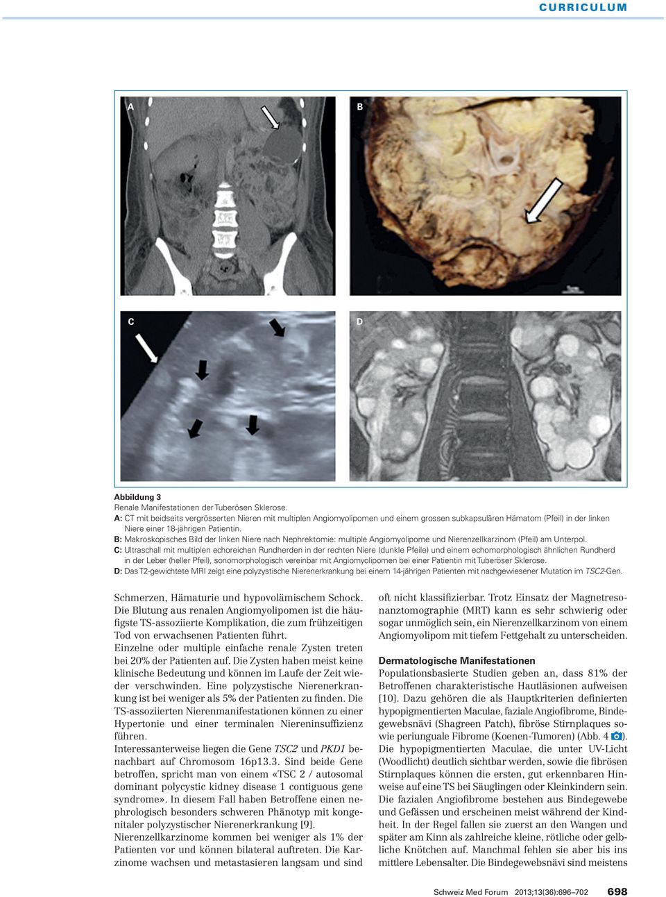 B: Makroskopisches Bild der linken Niere nach Nephrektomie: multiple Angiomyolipome und Nierenzellkarzinom (Pfeil) am Unterpol.
