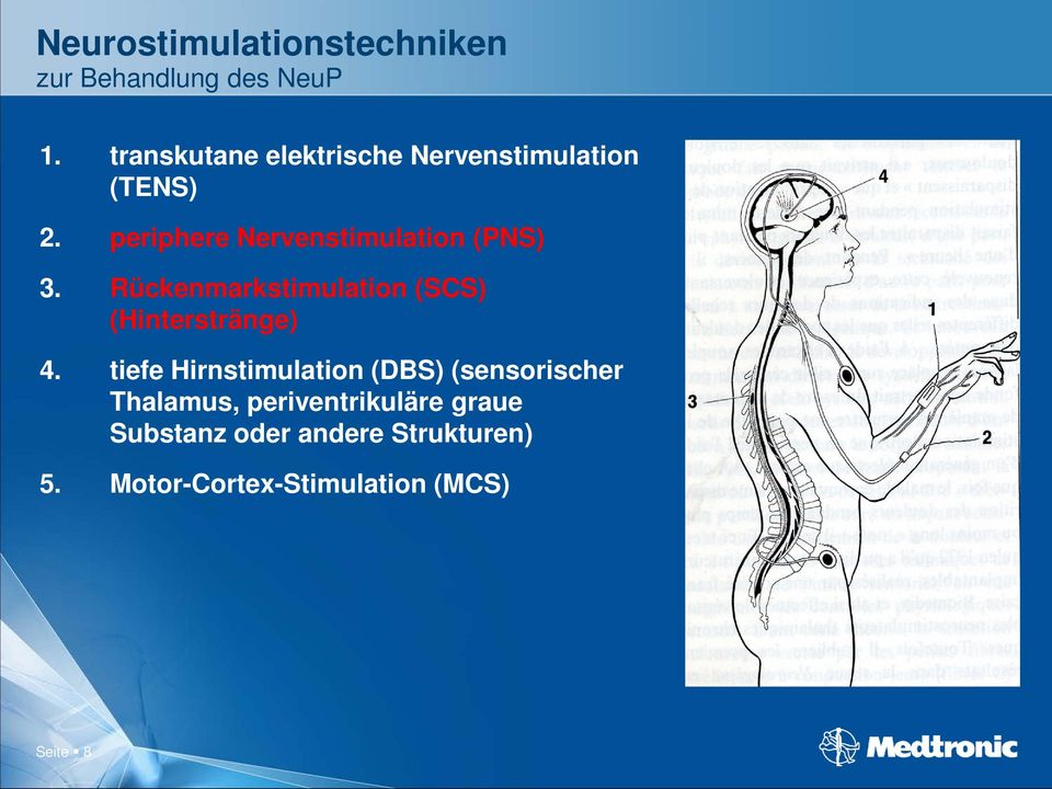 periphere Nervenstimulation (PNS) 3. Rückenmarkstimulation (SCS) (Hinterstränge) 4.