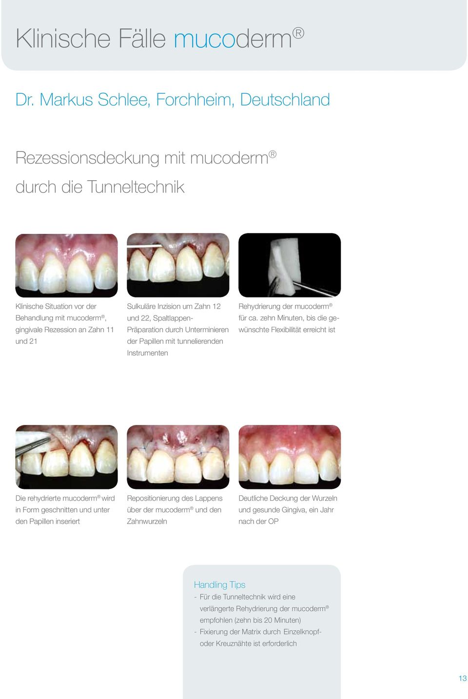 Inzision um Zahn 12 und 22, Spaltlappen- Präparation durch Unterminieren der Papillen mit tunnelierenden Instrumenten Rehydrierung der mucoderm für ca.