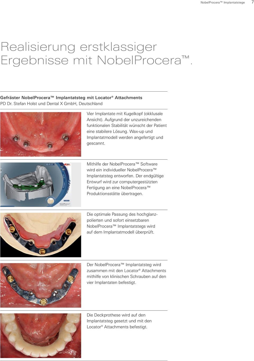 Wax-up und Implantatmodell werden angefertigt und gescannt. Mithilfe der NobelProcera Software wird ein individueller NobelProcera Implantatsteg entworfen.